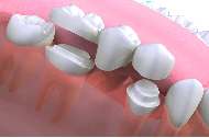 dental bridges essex