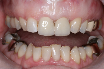 Patient after dental crowns