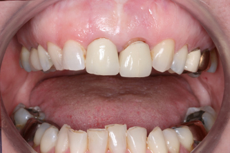 Patient before dental crowns