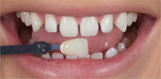 Teeth Whitening Chelmsford After - Advance Dental Clinic