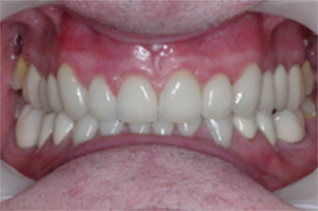 After Cosmetic Dentistry Chelmsford - Advance Dental Clinic