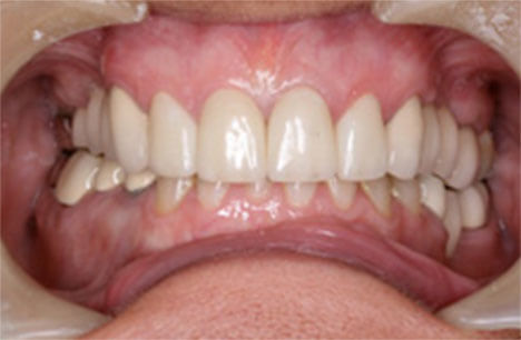 After Cosmetic Dentistry Chelmsford - Advance Dental Clinic