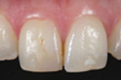Before Cosmetic Dentistry Chelmsford - Advance Dental Clinic