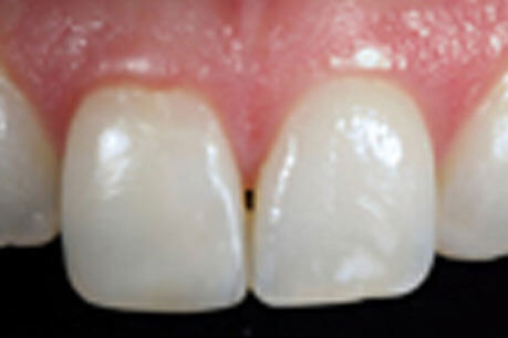 After Cosmetic Dentistry Essex - Advance Dental Clinic
