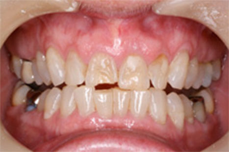 Before Cosmetic Dentistry Essex - Advance Dental Clinic