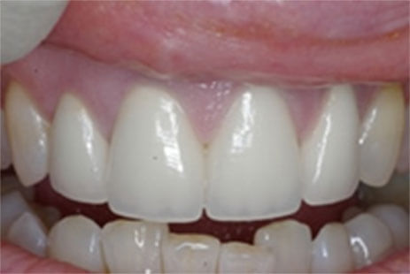 After Cosmetic Dentistry Essex - Advance Dental Clinic