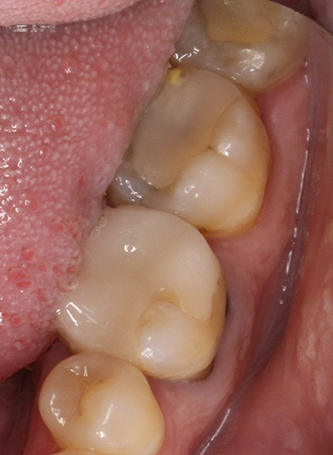 Before dental crown treatment