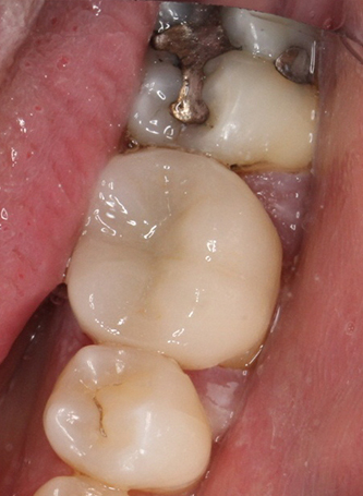 After dental crown treatment