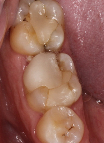Before dental crown treatment