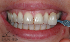 Teeth Whitening Chelmsford Before - Advance Dental Clinic