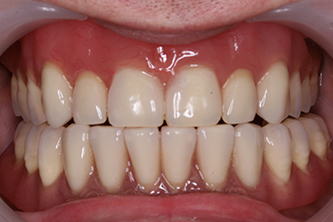 After dental implants Chelmsford