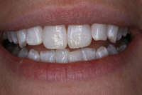 Teeth Whitening Essex After - Advance Dental Clinic