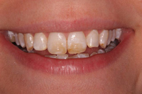 Teeth Whitening Essex Before - Advance Dental Clinic