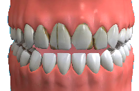 Dental Veneers Essex - Advance Dental Clinic