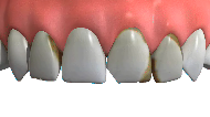 Dental Veneers Essex