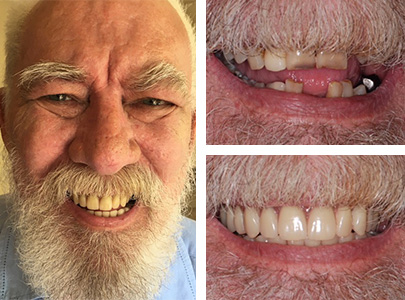Gerald's Smile after dental implants in Chelmsford, Essex - Advance Dental Clinic