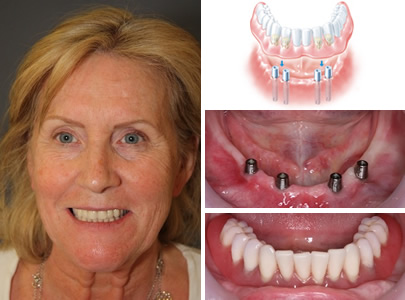 SynCone Smile Dental Implants in Chelmsford, Essex - Advance Dental Clinic