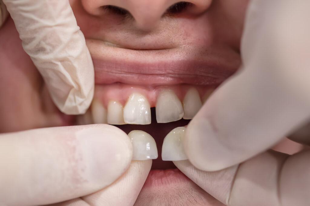 Veneers Essex - Advance Dental Clinic