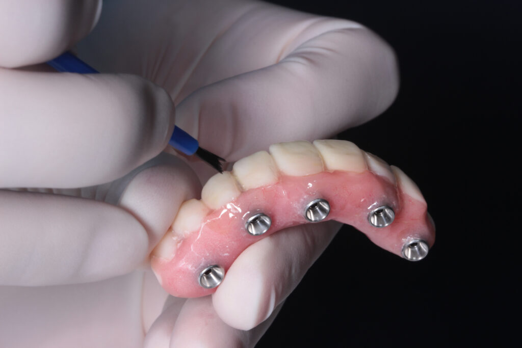 Dental implants Chelmsford - Advance Dental Clinic